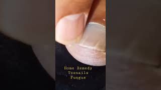 Home Remedy Cure for Toenails Fungus [upl. by Iridis]