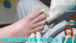 Neglected nails feet κεντροποδιου foot footcare podologos orthotics calluses podiatrist [upl. by Annawahs]