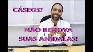 Você tem CÁSEOS Não REMOVA suas AMÍDALAS [upl. by Biddle]