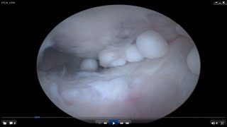 Loose Bodies in the Knee Joint A brief video [upl. by Olifoet]