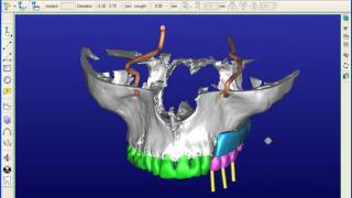 Dr Dov Kischinovsky  Long implants in the pterygoid region [upl. by Margo]