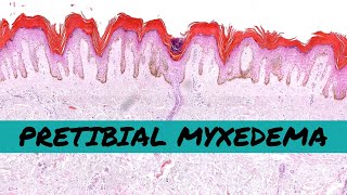 Pretibial Myxedema thyroid dermopathy of Graves disease hyperthyroidism [upl. by Ardnik639]