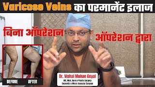 Varicose Veins से परमानेंट छुटकारा पाएं। What is the treatment for varicose veins Dr Vishal Goyal [upl. by Clova]