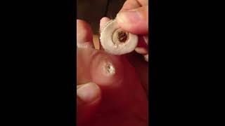 Nasty and gross plantar wart on bottom of foot [upl. by Dustman]