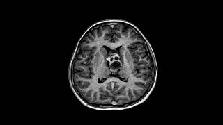 11 year old girl with mixed tumor teratoma and germinoma based on histopathology diagnosis [upl. by Linus]