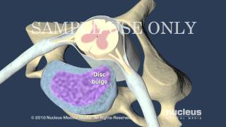 Cervical Disc Herniation [upl. by Notyarb]