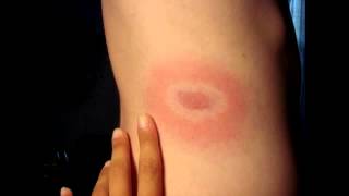 Erythema Chronicum Migrans from Ixodes Tick Bite Lyme Disease Borrelia [upl. by Ahsote]