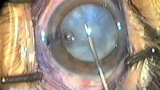 Capsulorhexis of a white hypermature intumescent cataract  How to prevent Argentianian Flag Sign [upl. by Nirra]