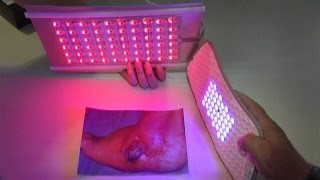 Medilight  Lichttherapie gegen chronische Wunden [upl. by Enialehs]