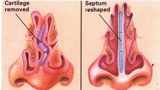 septoplasty surgery ENT [upl. by Knighton]