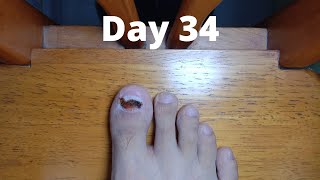 Toenail Timelapse [upl. by Chenee]