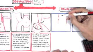 Bowel Obstruction  Causes and Pathophysiology [upl. by Etnohc]