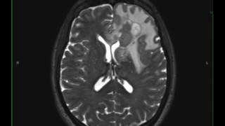 Grade 3 Anaplastic Astrocytoma [upl. by Conall]