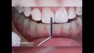 Composite Veneers step by step  All the Secrets [upl. by Jeniece72]