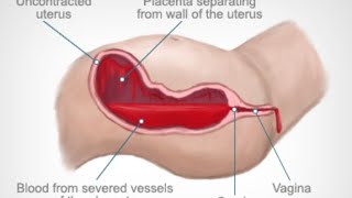 Doctor explains HEMORRHOIDS aka piles  Causes symptoms treatment amp prevention [upl. by Pinette]