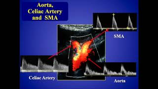 Mesenteric Ischemia [upl. by Merilee799]