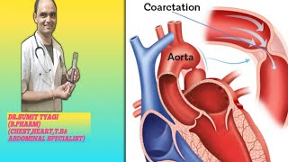 COARCTATION OF THE AORTA BY DRSUMIT TYAGISUMITMEDICALDISPENSARY1 [upl. by Sllew]