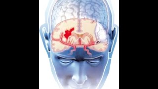 Tratamiento de aneurismas cerebrales ACV [upl. by Andy]