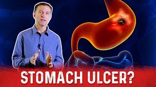 How To Get Rid Of Stomach Ulcer – DrBerg On Peptic Ulcer Treatment [upl. by Hefter]