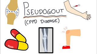 Pseudogout Calcium Pyrophosphate Disease  Simple and easy to understand [upl. by Lupiv]