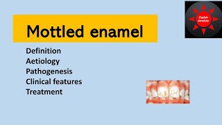 Mottled enamel  Oral pathology  Enamel hypoplasia due to fluoride [upl. by Launce379]