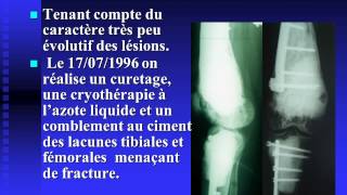 Hémangioendothéliome épithélioïde multifocal du membre inférieur [upl. by Pizor510]