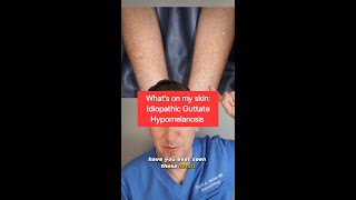 Dermatologist explains Idiopathic Guttate Hypomelanosis White arm spots derm skin todayIlearned [upl. by Dabbs]