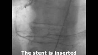 What A Diffenence A Stent Makes [upl. by Beka]