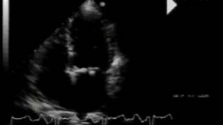 calcific aortic stenosismitral annular calcification and flail mitral valve 22 [upl. by Epillihp]