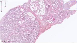 Nodular Prostatic Hyperplasia  Histopathology [upl. by Llyrrad]