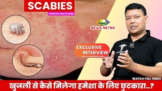 कहीं आपकी खुजली खतरे की घंटी तो नहीं  How to treat Scabies  Dr Mahendra Rana  sacabies [upl. by Melak]