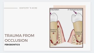 TRAUMA FROM OCCLUSION [upl. by Onairelav]