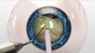 Cataract Surgery Finevision Triumf Trifocal IOL implantation Katarakt Cerrahisi Trifokal Lens [upl. by Stevena416]