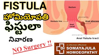 Cure FISTULA without Surgery  Permanent Homeopathy treatment for Anal Fistula  TELUGU [upl. by Mattland]