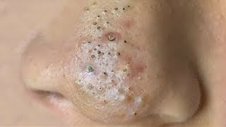 Big Cystic Acne Blackheads Extraction Blackheads amp Milia Whiteheads Removal Pimple Popping  4439 [upl. by Lairret]