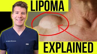 Doctor explains LIPOMA  Symptoms clinical photos and treatment [upl. by Gney]