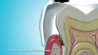 Perio Tray® by Perio Protect  NonInvasive Treatment for Gum Disease [upl. by Breban]