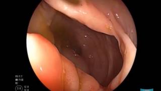 Nonsteroidal Antiinflammatory Drug Induced Colonic Ulcer [upl. by Ferro315]