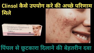 clinsol gel  Clinsol Gel Review  Clinsol Gel for Pimples  Clinsol Gel Review in hindi  uses [upl. by Akemaj]