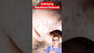 Crazy BLACKHEAD REMOVAL  Blackhead Extraction shorts [upl. by Werra836]