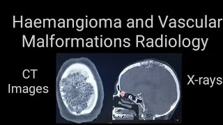 Hamangioma and vascular malformations Radiology Xrays and CT images [upl. by Mendez]