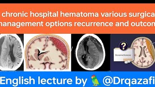 chronic subdural hematomaEnglish lecture evaluation various surgical treatment options and outcome [upl. by Dotson]