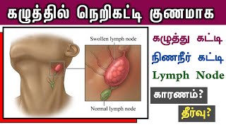 கழுத்தில் நெறிகட்டுதல் குணமாக  நிணநீர் கட்டி  lymph nodes in the neck treatment  Next Day 360 [upl. by Bigner855]