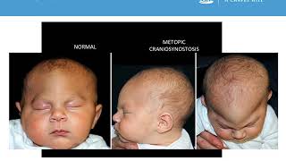 Neurosurgery Medical Student Primer  Craniosynostosis [upl. by Arlee]