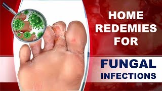 How to Cure Fungal Infection Using Home Remedies [upl. by Ormiston]