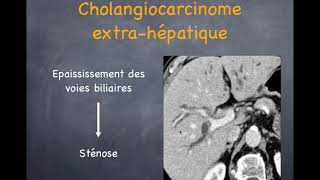 Tumeurs du foie  Malignes  3 Cholangiocarcinome [upl. by Cohla959]