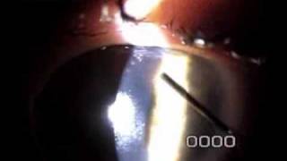 Slit Lamp Techniques  Epithelial Ingrowth Removal 8 days after LASIK Enhancement [upl. by Ewen]