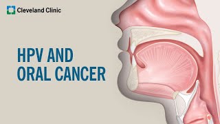 What Is HPVRelated Oral Cancer [upl. by Herm]