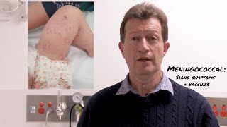 Meningococcal Disease Signs Symptoms and Vaccines [upl. by Osana215]