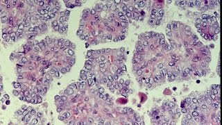 Thyroid Neoplasms  Pathology mini tutorial [upl. by Ateuqram]